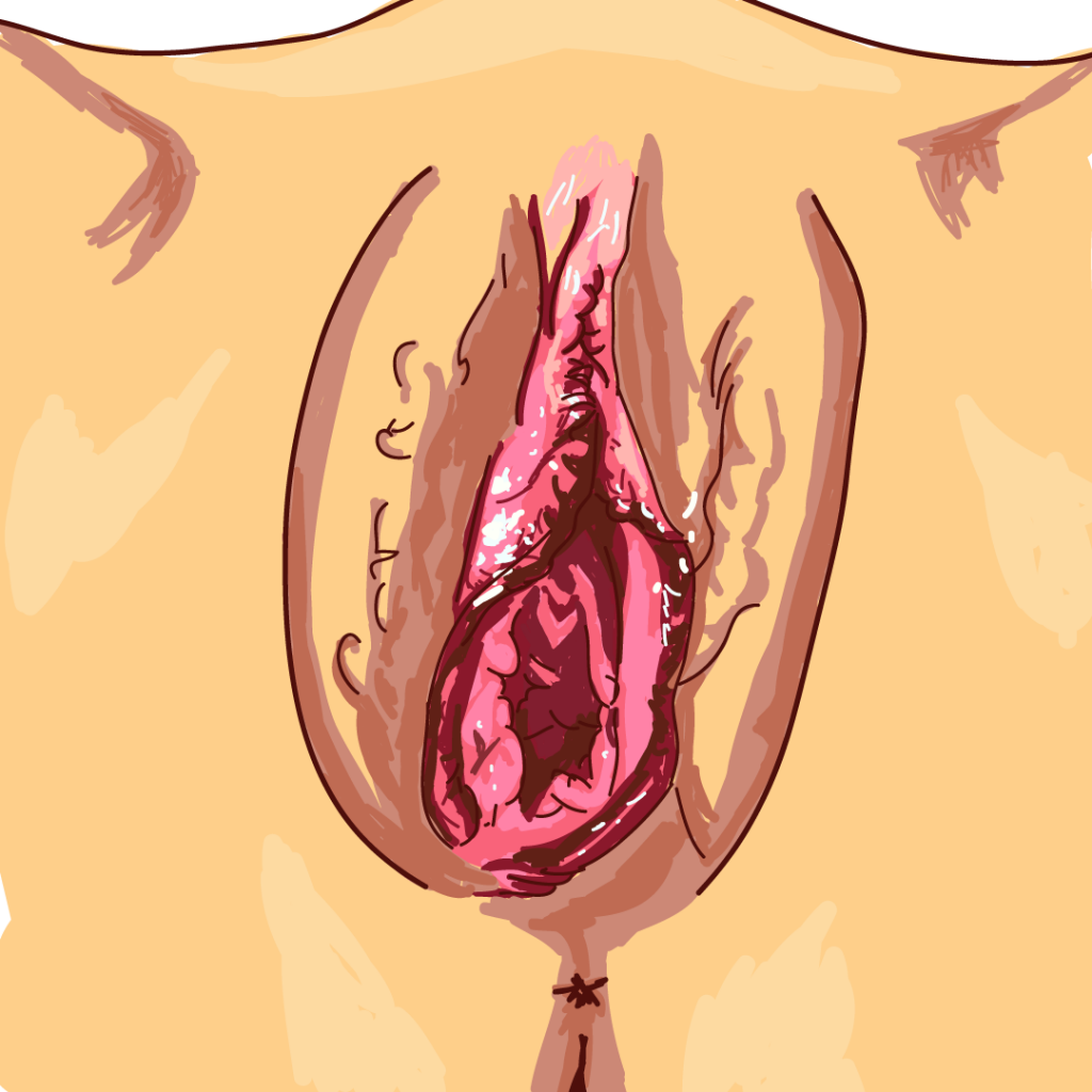 Vaginoplastia con Láser​