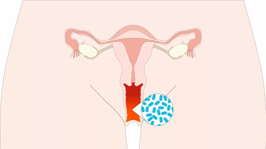 Tratamiento Infecciones Vaginales Recurrentes