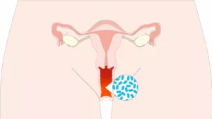 Tratamiento Infecciones Vaginales Recurrentes